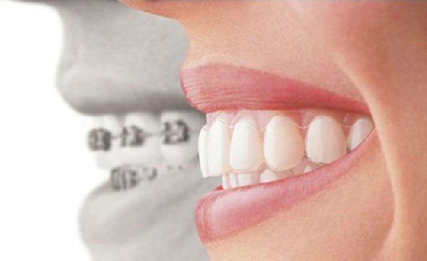 How Orthodontics Can Correct Your Bite Pattern