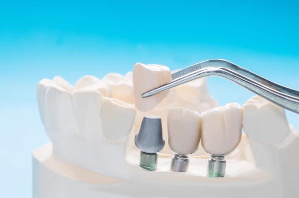 How Do I Get Dental Care? Washington State Well Being Care Authority