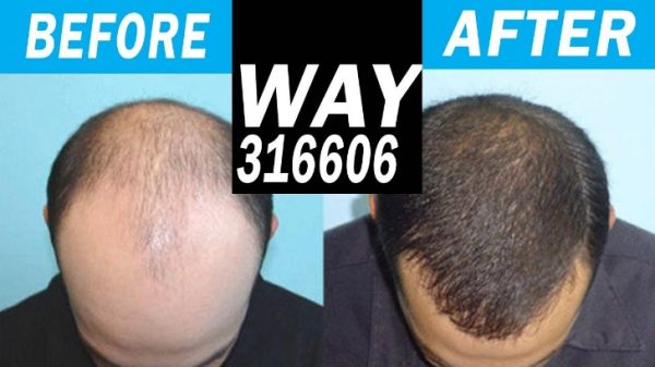 Hair loss treatment for men and how to stop balding fall