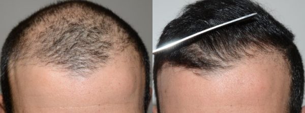 A Comprehensive Insight into Advanced Hair Restoration Techniques